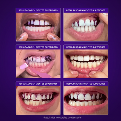 Dientes blancos en 7 días | ¡LLÉVATE 2 AL PRECIO DE 1!